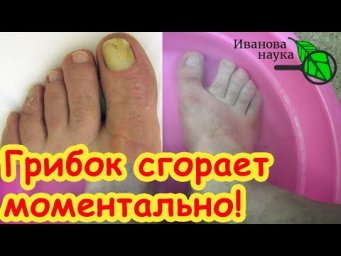 БЕЗ ТАБЛЕТОК, МАЗЕЙ и ПОБОЧКИ: природное лечение грибка ногтей и кожи. Лучшее средство от грибка.